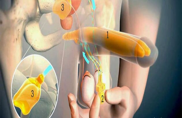 Lipofilling -Operation
